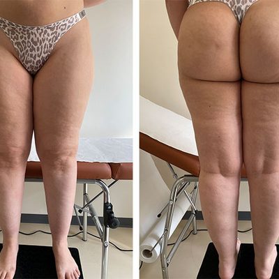 La liposuzione o lipoaspirazione: tutto quello che devi sapere