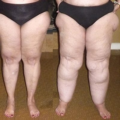 Il percorso di cura della paziente con lipedema