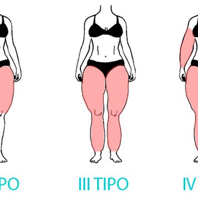 La preparazione alla liposuzione LRS (Lipedema Reduction Surgery)