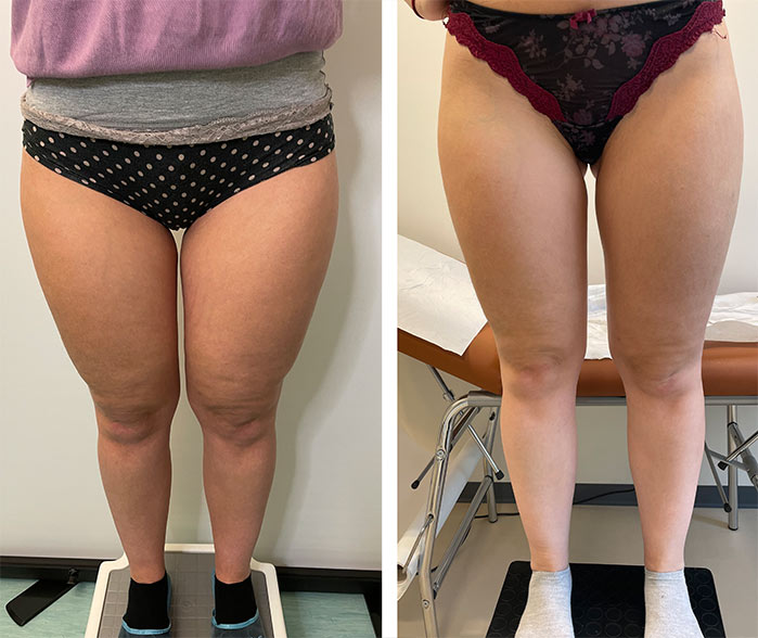 Il trattamento del lipedema e del grasso delle gambe a Milano