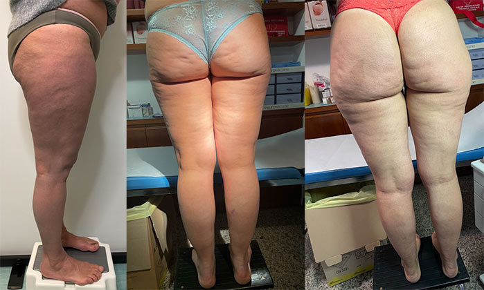 Il trattamento della cellulite a Milano