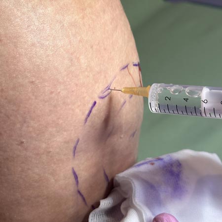 Fosfatidilcolina per mesoterapia Lipodissolve