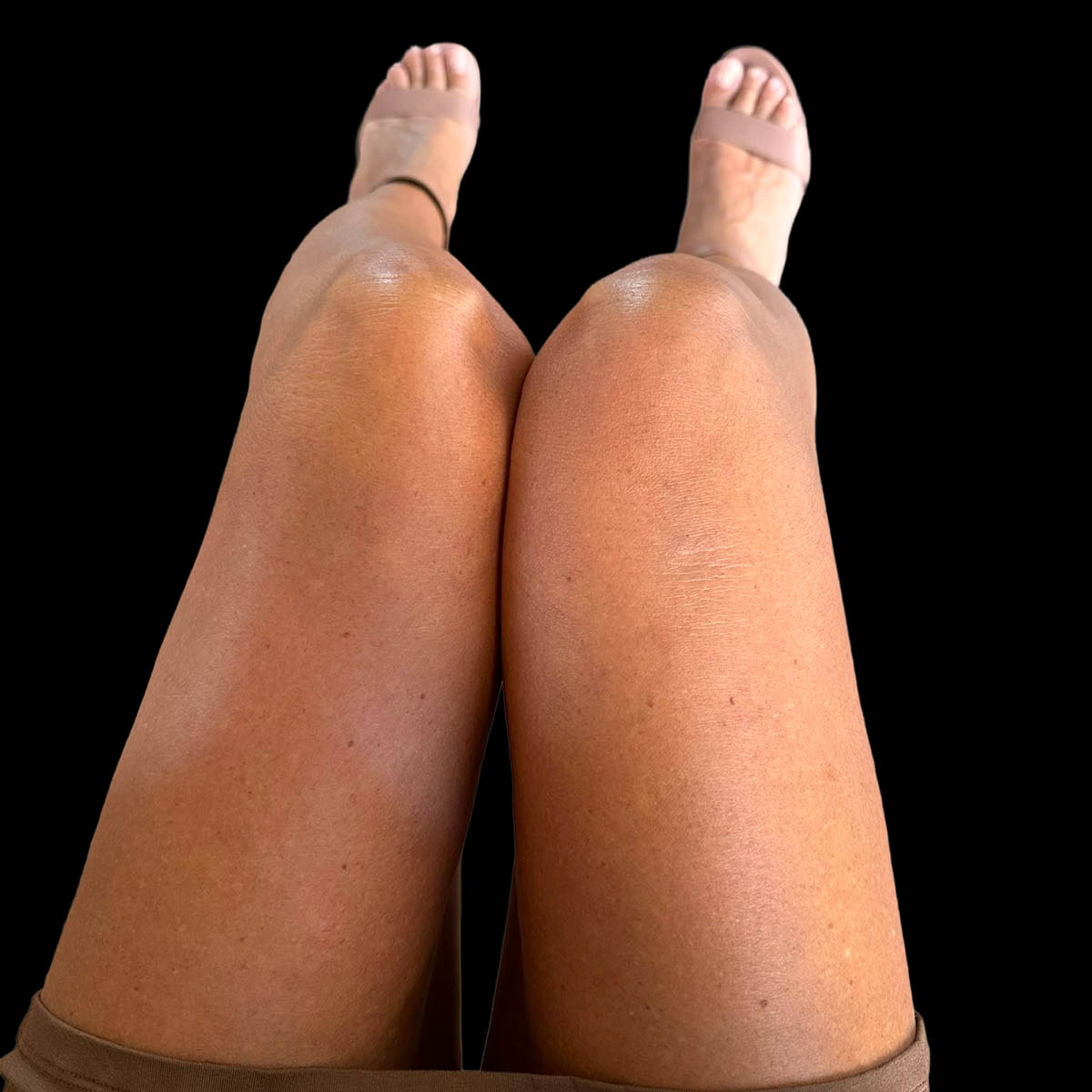 Gambe belle e senza più lassità cutanea dopo il trattamento Sculptra