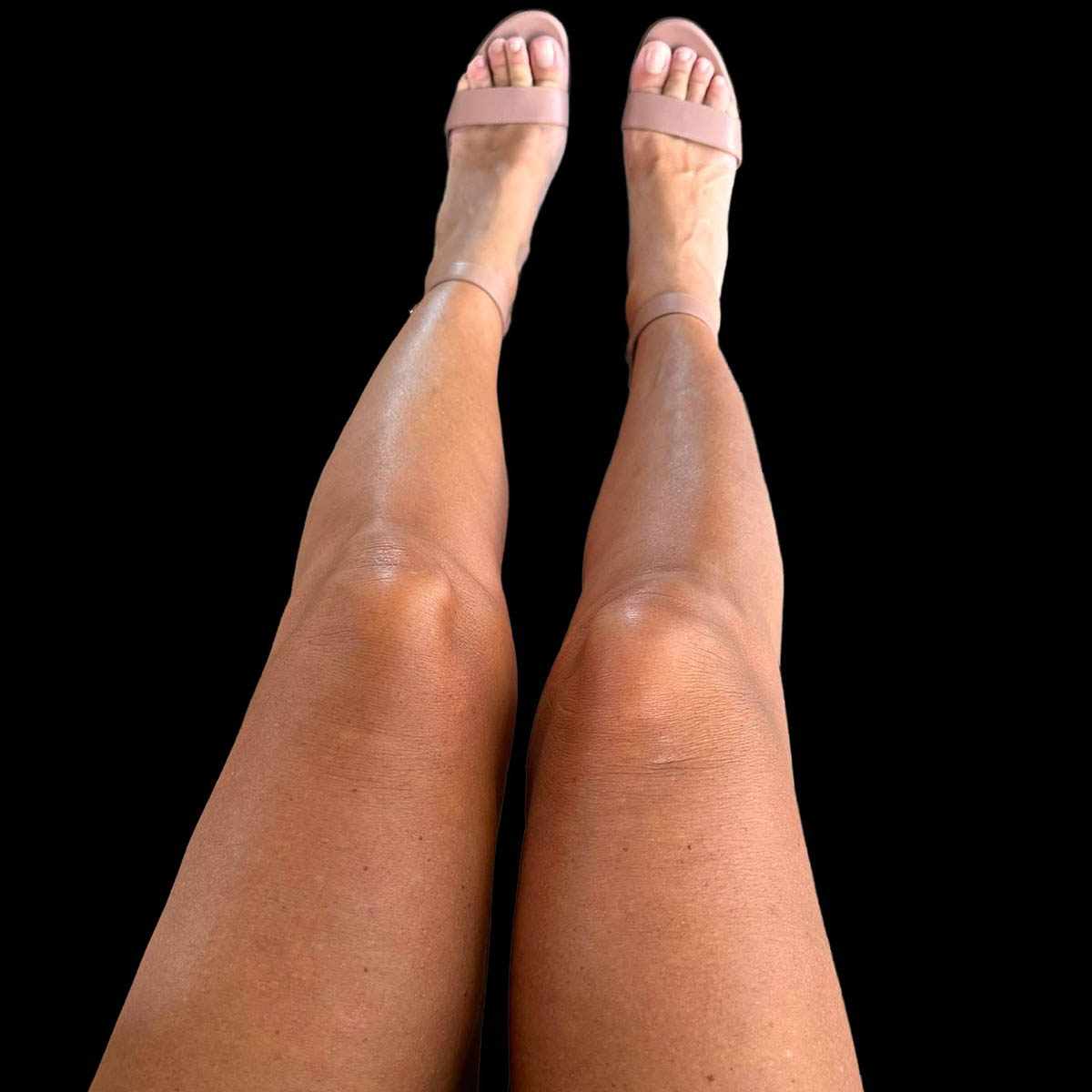 Gambe belle e senza più lassità cutanea dopo il trattamento Sculptra, anche per over 60