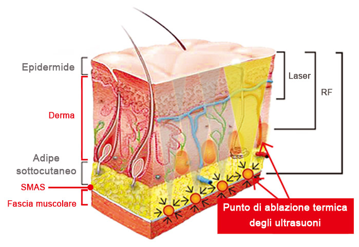 L'HiFu per il lipedema a Milano