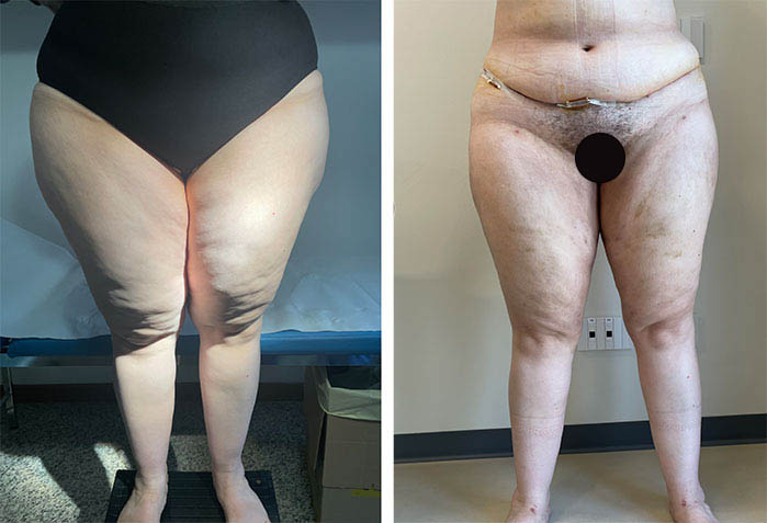 La liposuzione per il lipedema a Milano