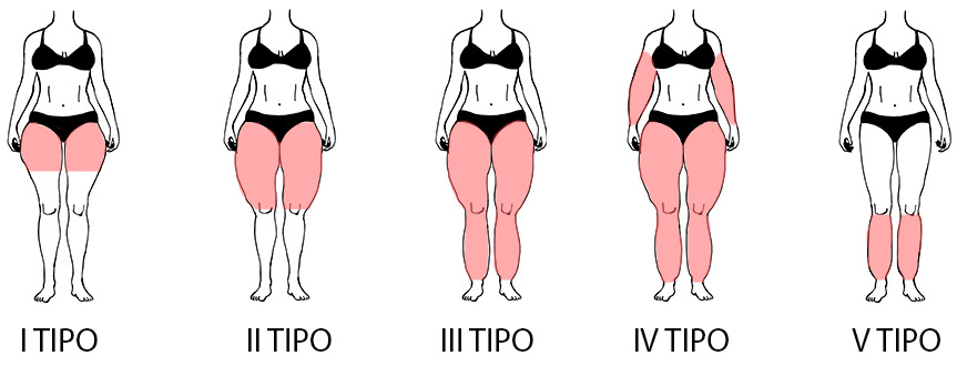 La liposuzione per il lipedema a Milano