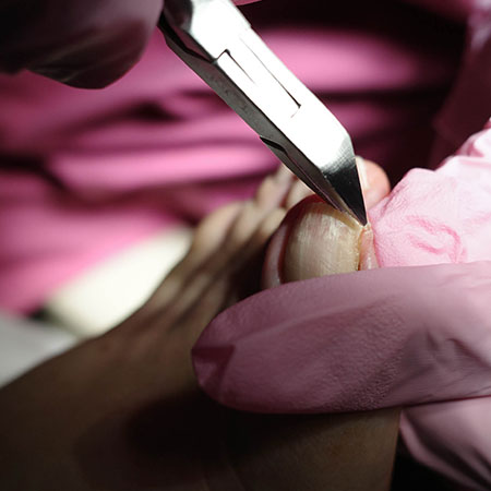 Pedicure sanitaria su unghie dismorfiche di paziente anziano