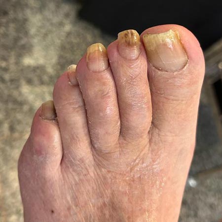 Pedicure sanitaria su unghie dismorfiche di paziente anziano