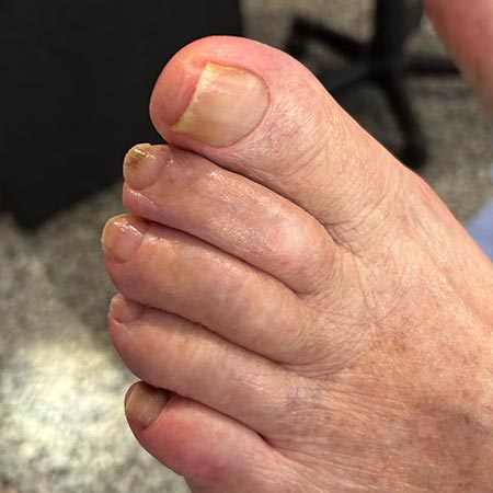 Pedicure sanitaria su unghie dismorfiche di paziente anziano