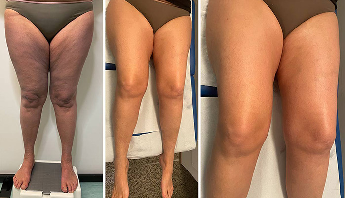 Radiofrequenza Medica a Milano per cosce e gambe