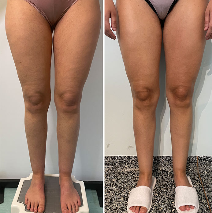 Radiofrequenza Medica a Milano per cosce e gambe