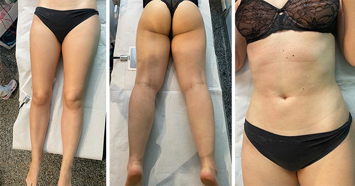 Radiofrequenza Medica a Milano per cosce e gambe