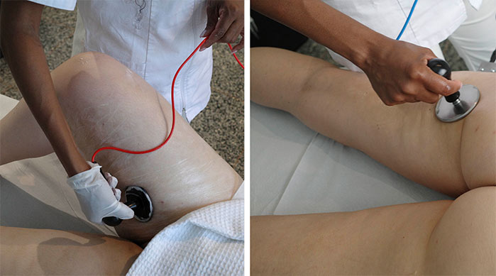 Cavitazione Medica a Milano