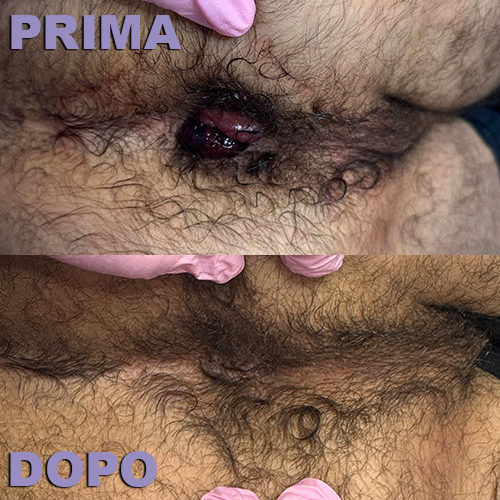 Scleromousse contro il prolasso emorroidale