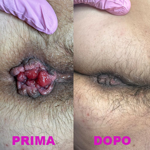 Scleromousse contro il prolasso emorroidale