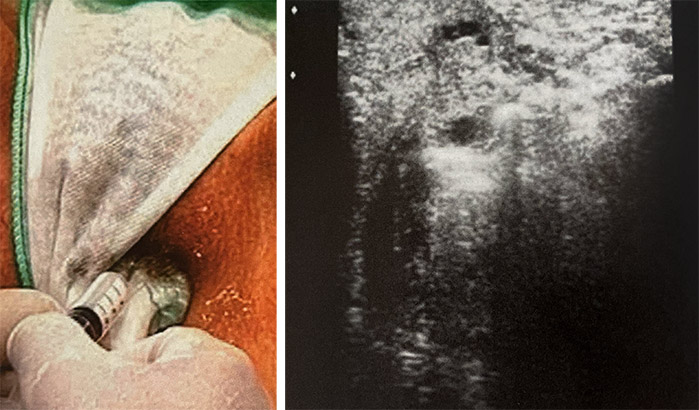 La scleroterapia per eliminare le vene varicose e le teleangectasie