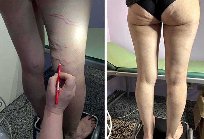 La scleroterapia per eliminare le vene varicose e le teleangectasie