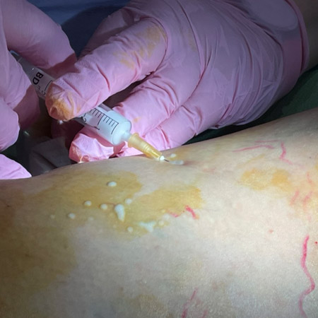 Scleromousse: iniezione della mousse sclerosante nella varice