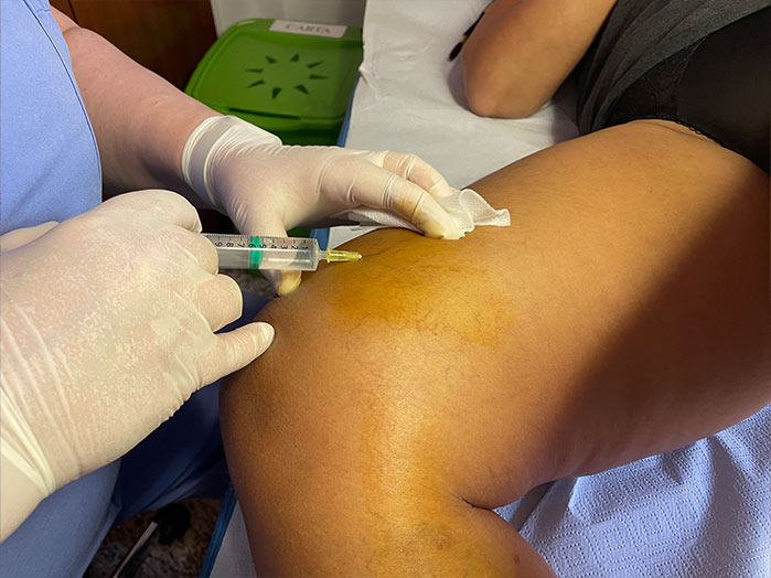 La scleroterapia per eliminare le vene varicose e le teleangectasie