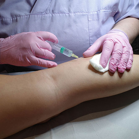 Scleromousse: iniezione della mousse sclerosante nella varice