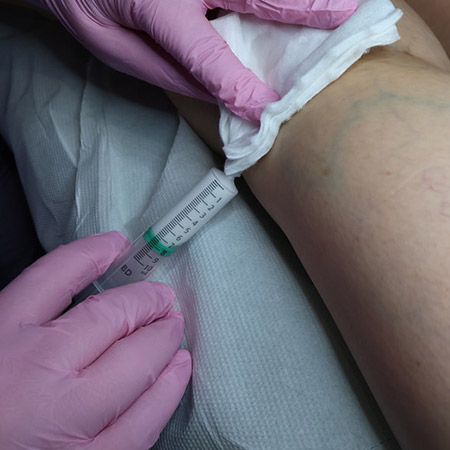 Scleromousse: iniezione della mousse sclerosante nella varice