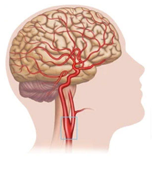 Lo screening delle carotidi a Milano