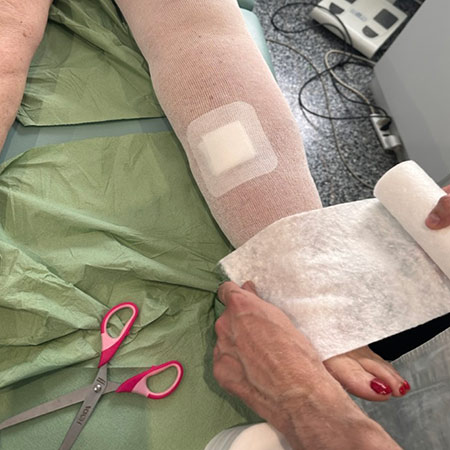 Terapia elastocompressiva del linfedema