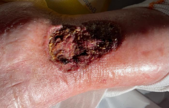 Ulcera venosa su varice della vena safena