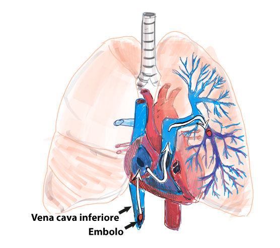 Embolia polmonare dovuta a Trombosi Venosa Profonda