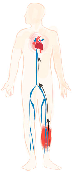 Il percorso dell'embolo durante un'embolia polmonare causata da una trombosi venosa profonda