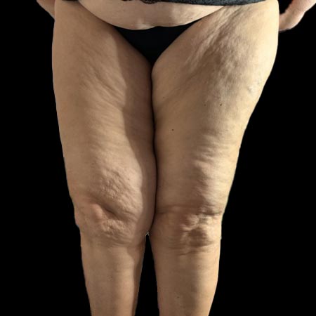 Lipedema di V stadio