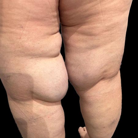 Gambe affette da lipedema IV grado