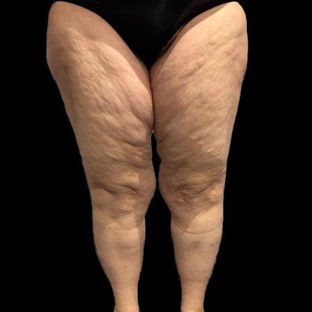 Gambe affette da lipedema IV grado su paziente di 41 anni
