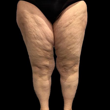 Gambe affette da lipedema IV grado