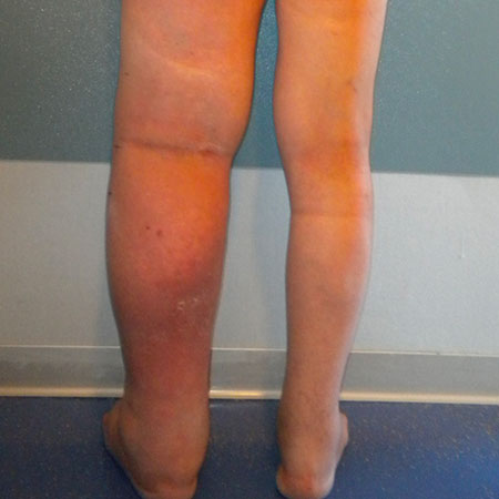 Linfedema dopo prostatectomia