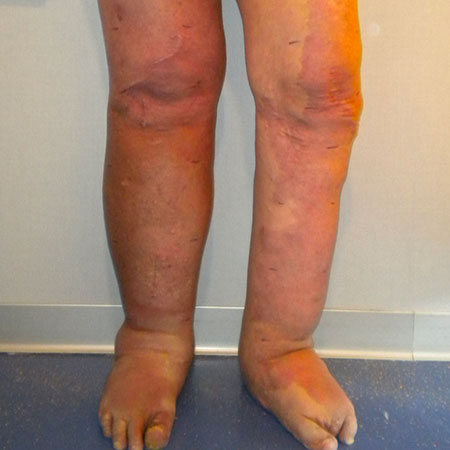 Linfedema con linfangite