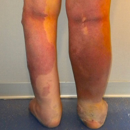Linfedema con linfangite