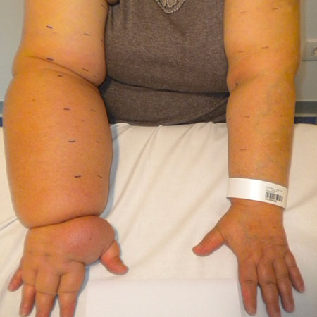Linfedema dopo mastectomia