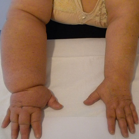 Linfedema dopo mastectomia
