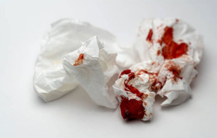 Il sangue sulla carta igienica e le emorroidi patologiche