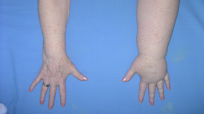 Il trattamento del linfedema a Milano
