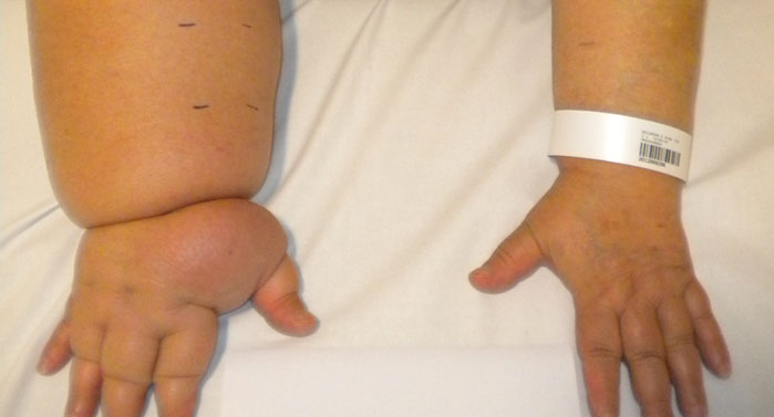 Il trattamento del linfedema a Milano