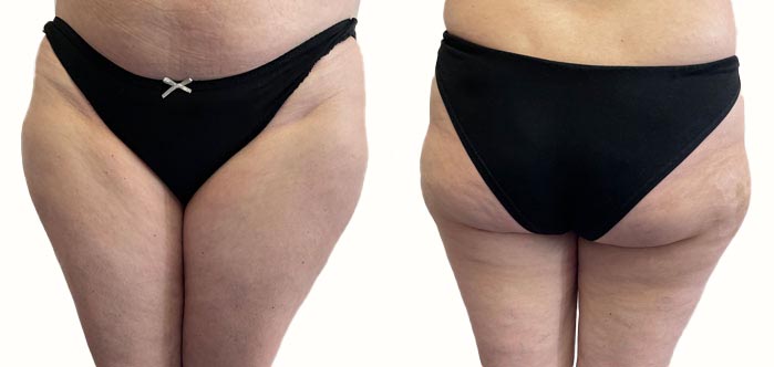 Il tipo di lipedema