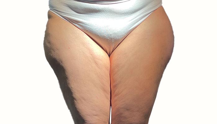 Il tipo di lipedema