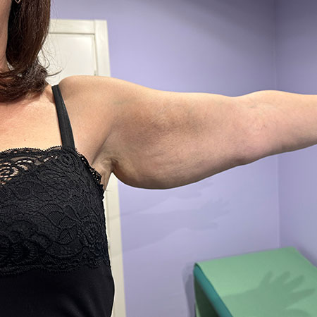 Lipedema delle braccia