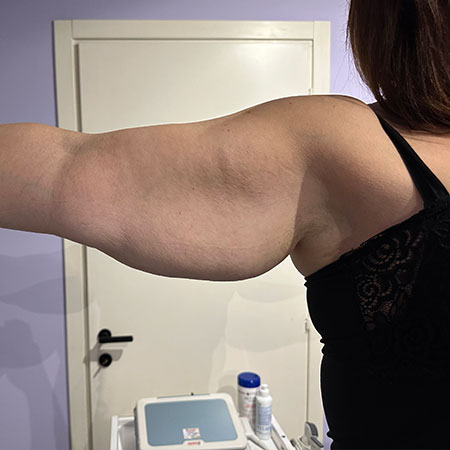 Lipedema delle braccia