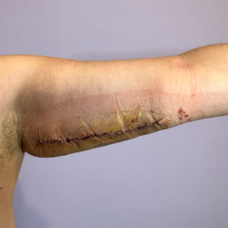 Lipedema delle braccia