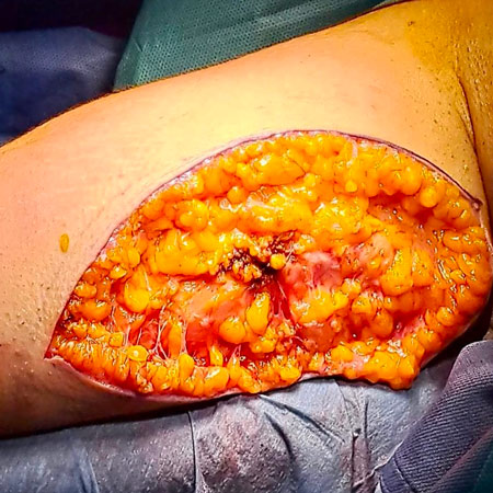 Lipedema delle braccia