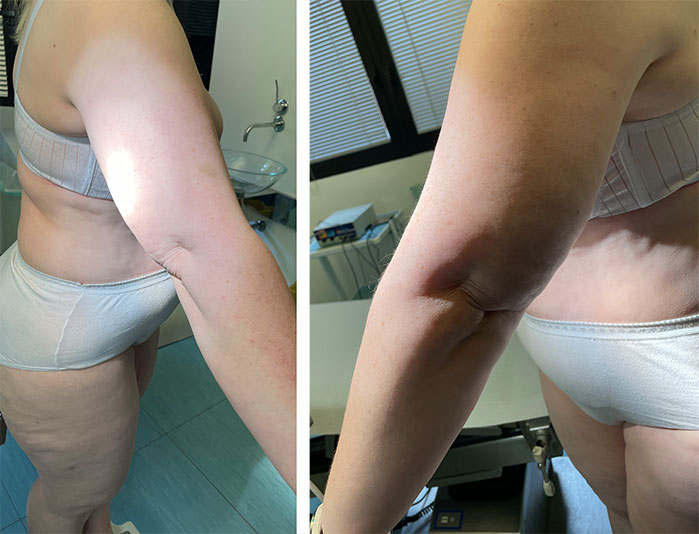 Il lipedema e il grasso sulle braccia: come risolverlo